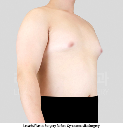 gynecomastia_02_01_250424