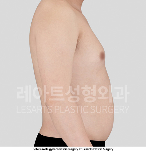 gynecomastia_02_02_250410