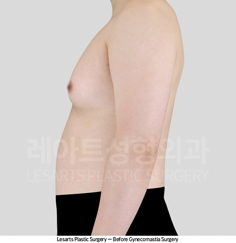 gynecomastia_02_02_250416