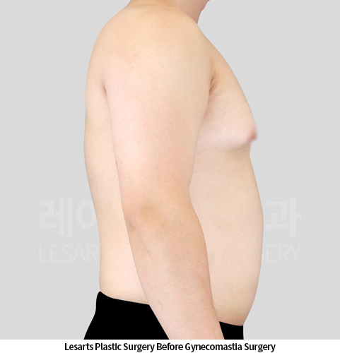gynecomastia_02_02_250424