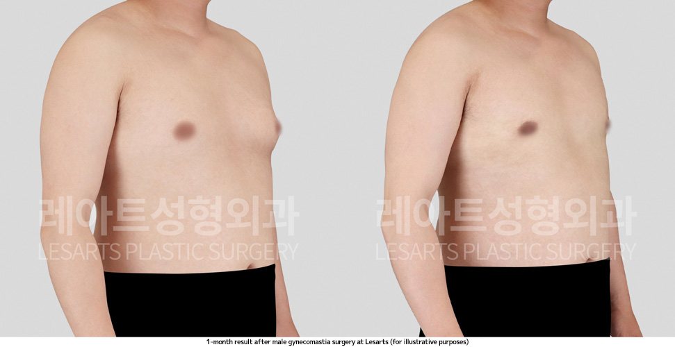 gynecomastia_02_03_250410