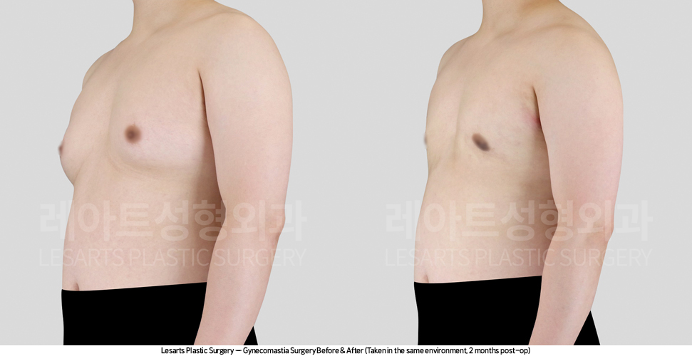 gynecomastia_02_03_250416
