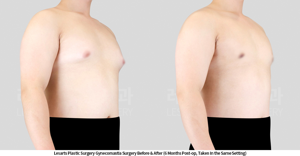 gynecomastia_02_03_250424