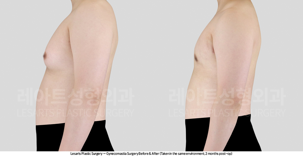 gynecomastia_02_04_250416