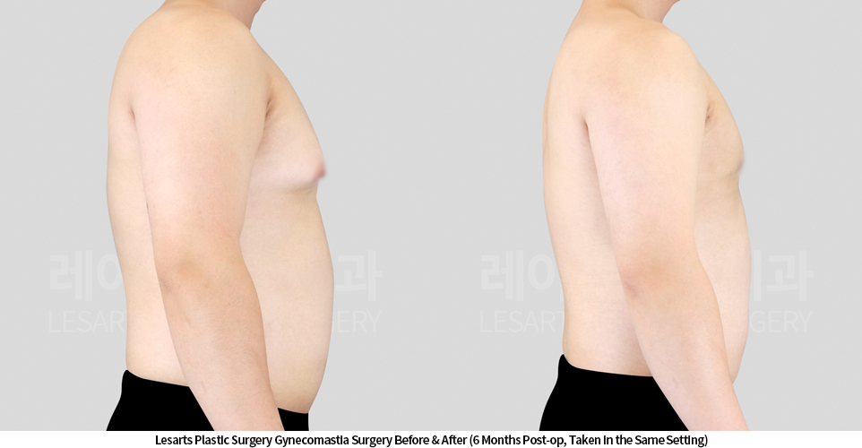 gynecomastia_02_04_250424