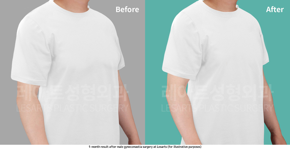 gynecomastia_02_05_250410