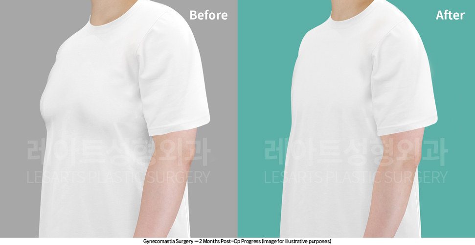 gynecomastia_02_05_250416