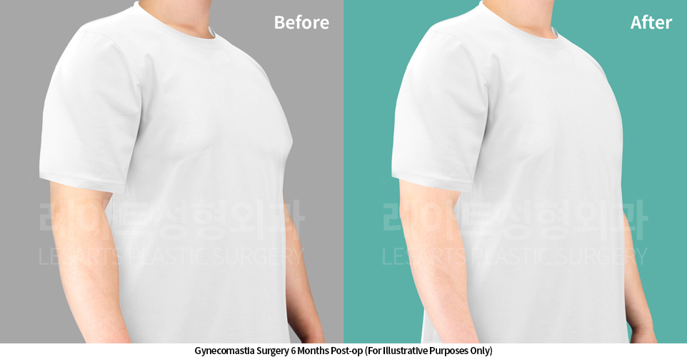 gynecomastia_02_05_250424