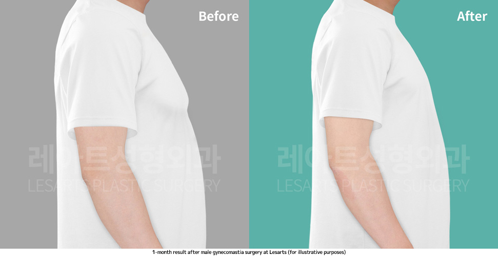 gynecomastia_02_06_250410