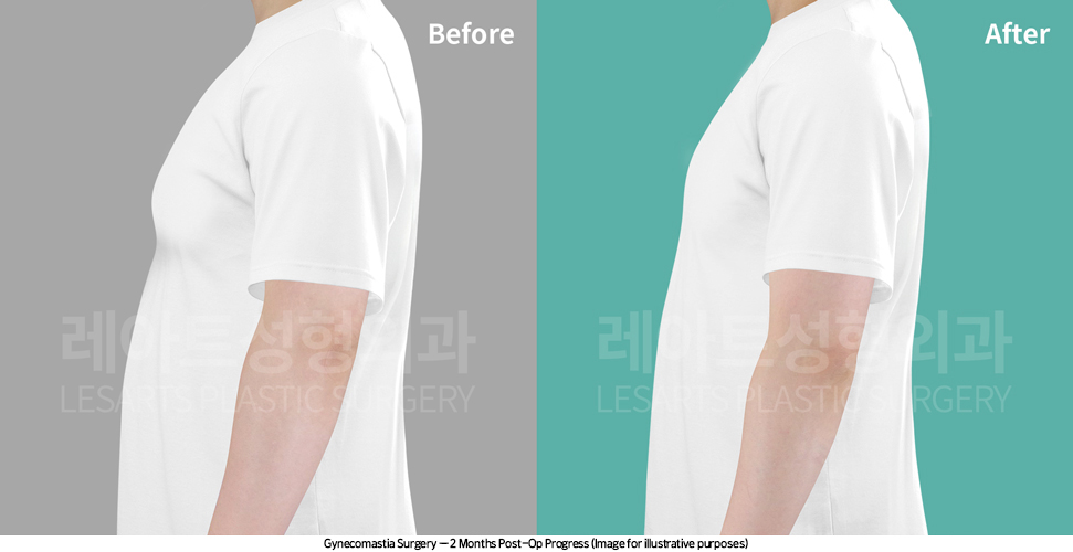 gynecomastia_02_06_250416