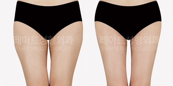 hip-dip-fat-transfer_01_thumbnail_250403