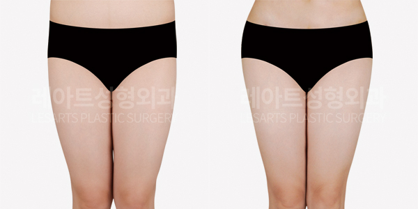 hip-dip-fat-transfer_01_thumbnail_250409