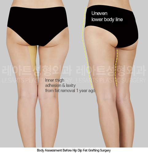 hip-dip-fat-transfer_02_01_250403