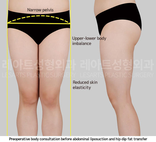 hip-dip-fat-transfer_02_01_250409
