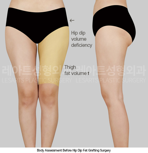 hip-dip-fat-transfer_02_02_250403