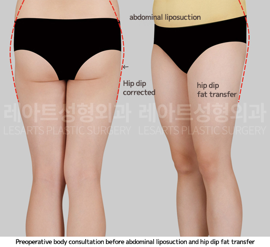 hip-dip-fat-transfer_02_02_250409