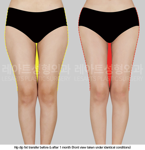 hip-dip-fat-transfer_02_03_250403