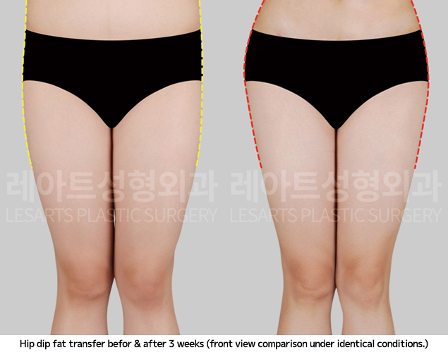 hip-dip-fat-transfer_02_03_250409