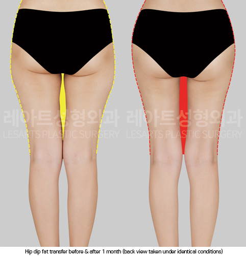 hip-dip-fat-transfer_02_04_250403