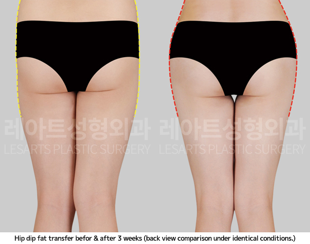 hip-dip-fat-transfer_02_04_250409