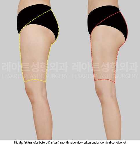 hip-dip-fat-transfer_02_05_250403