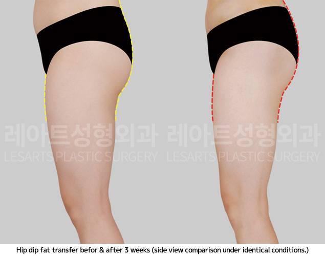 hip-dip-fat-transfer_02_05_250409