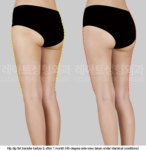 hip-dip-fat-transfer_02_06_250403