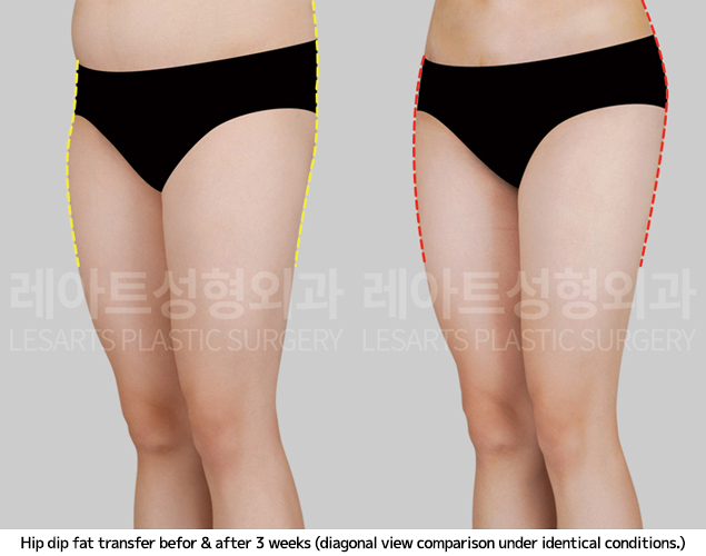 hip-dip-fat-transfer_02_06_250409