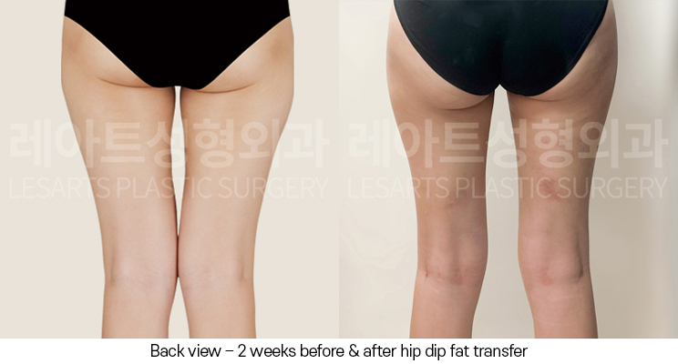 hip-dip-fat-transfer_02_08_250403