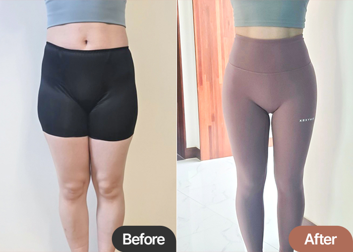 "Front and back changes after hip fat graft and liposuction in Korea"
