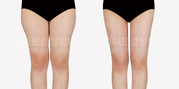 thigh_liposuction_01_thumbnail_250417