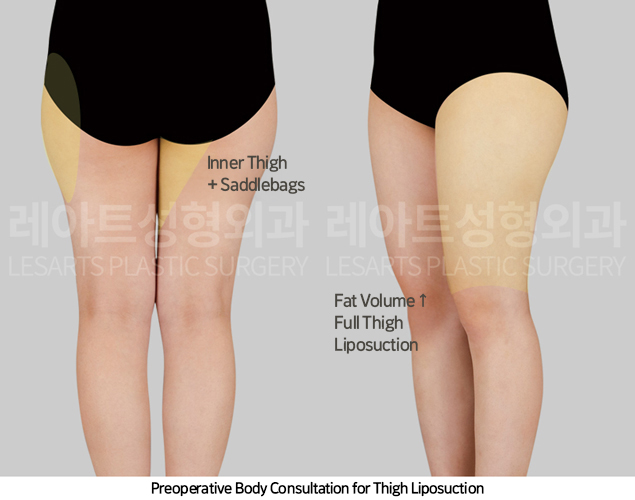 thigh_liposuction_02_02_250417