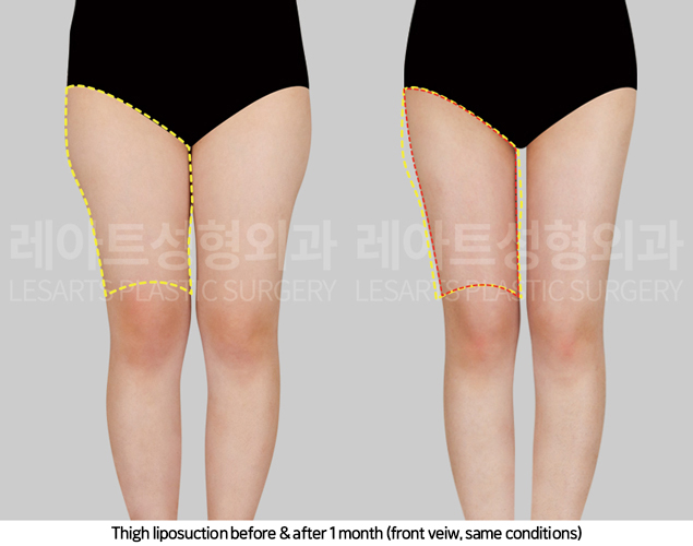 thigh_liposuction_02_03_250417