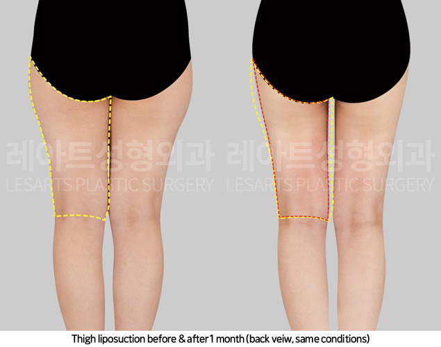 thigh_liposuction_02_04_250417