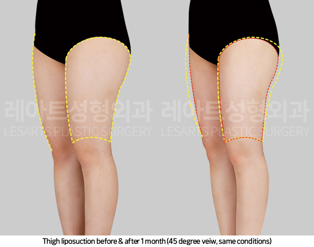 thigh_liposuction_02_06_250417