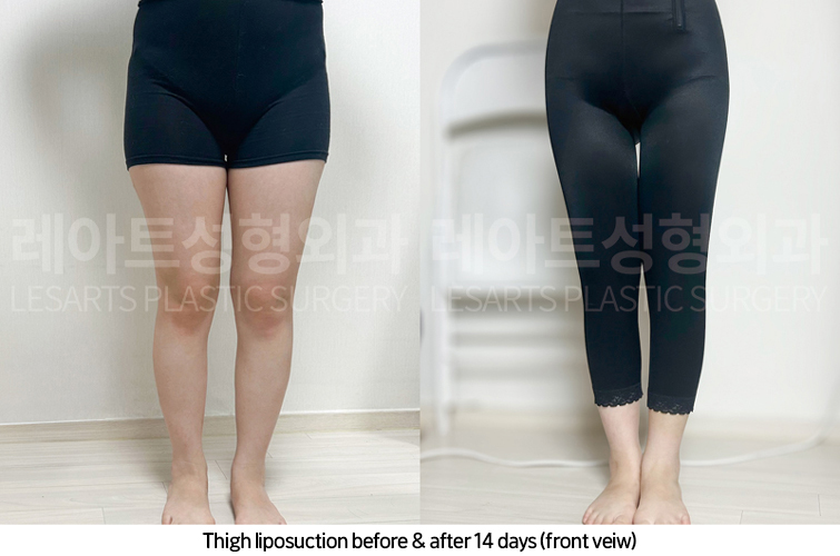 thigh_liposuction_02_07_250417