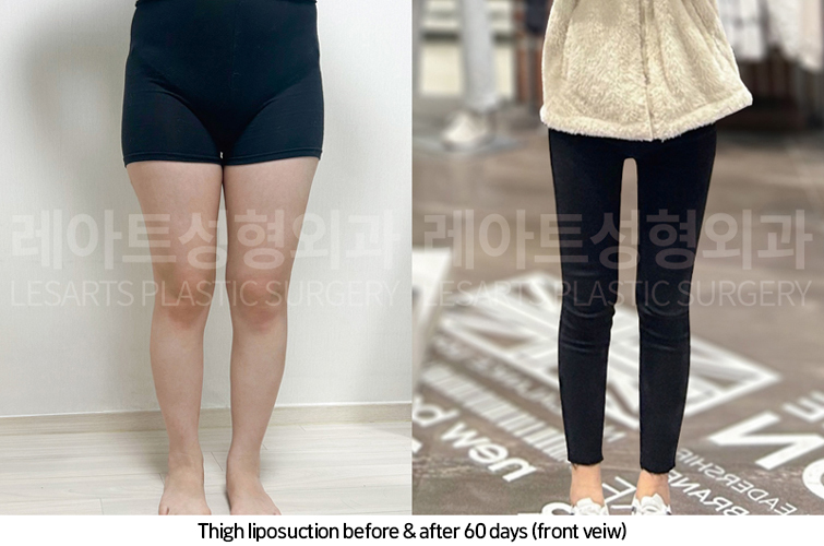 thigh_liposuction_02_08_250417