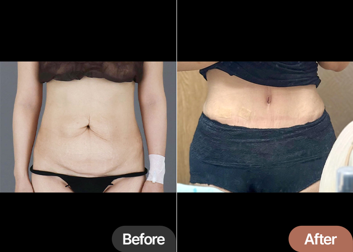 Tummy tuck before and after comparison – visible transformation at best hospital in Seoul