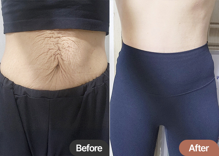 Tummy tuck revision before & after with abdominal liposuction in Gangnam – Best Plastic Surgery Clinic Lesarts