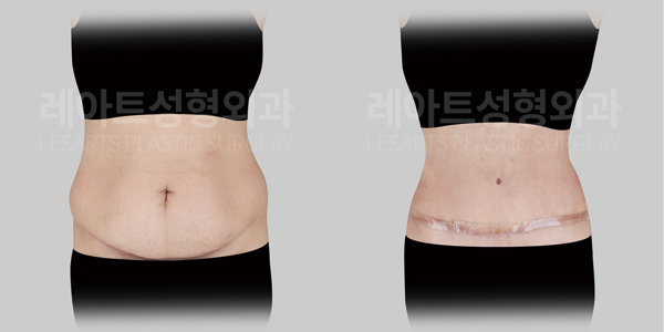 tummy_tuck_01_thumbnail_250408