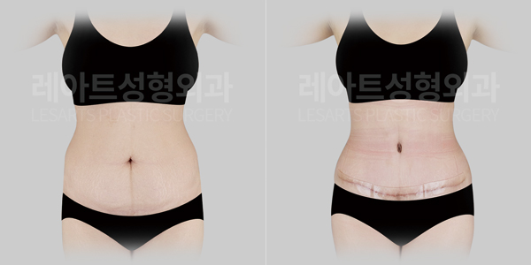 tummy_tuck_01_thumbnail_250414