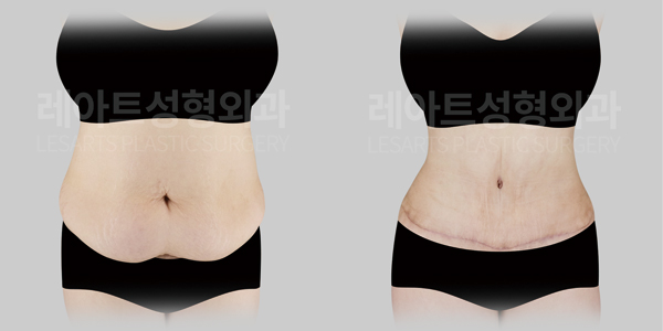 tummy_tuck_01_thumbnail_250421