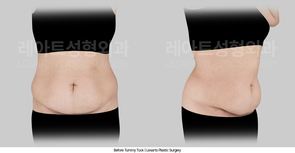 tummy_tuck_02_01_250408