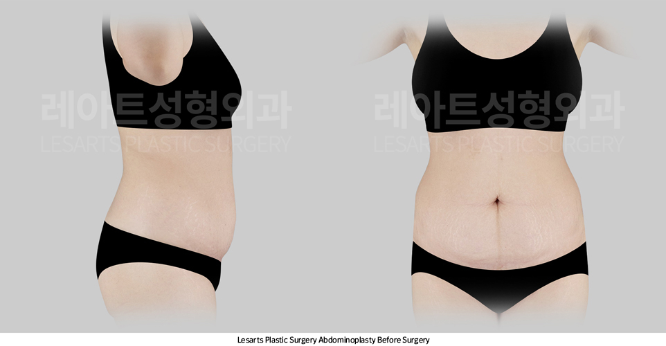 tummy_tuck_02_01_250414
