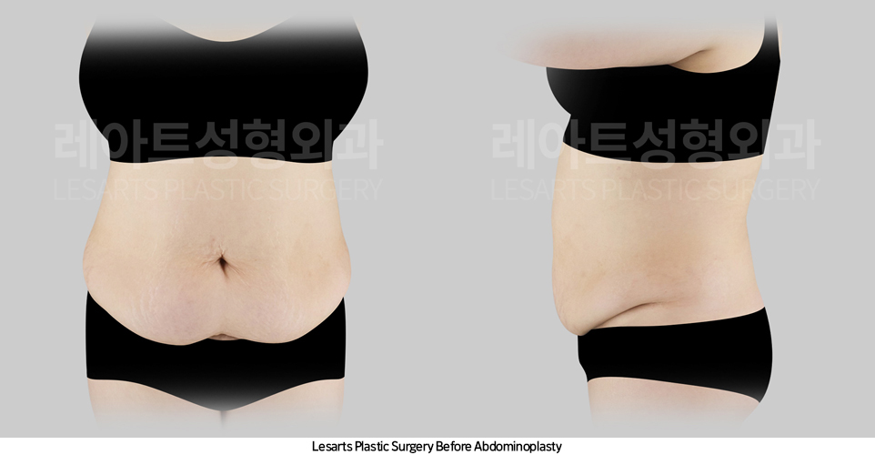 tummy_tuck_02_01_250421