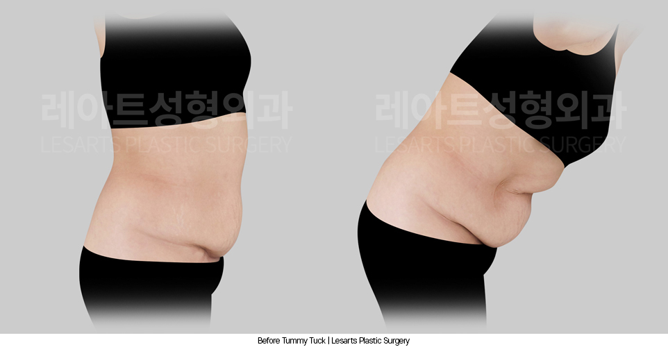 tummy_tuck_02_02_250408