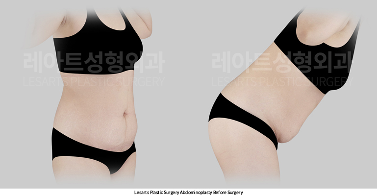 tummy_tuck_02_02_250414