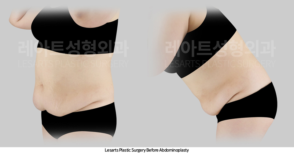 tummy_tuck_02_02_250421