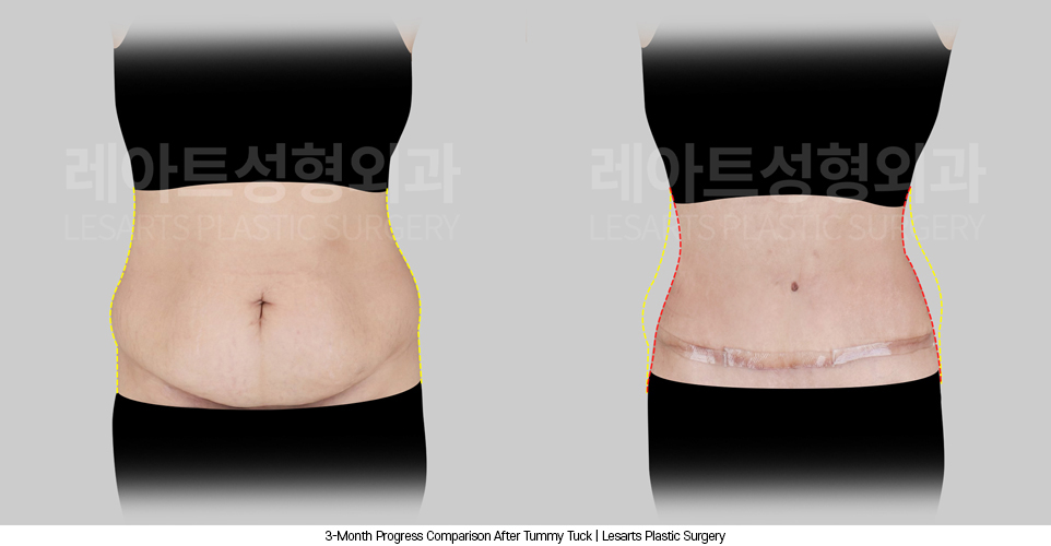 tummy_tuck_02_03_250408