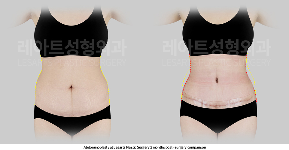 tummy_tuck_02_03_250414